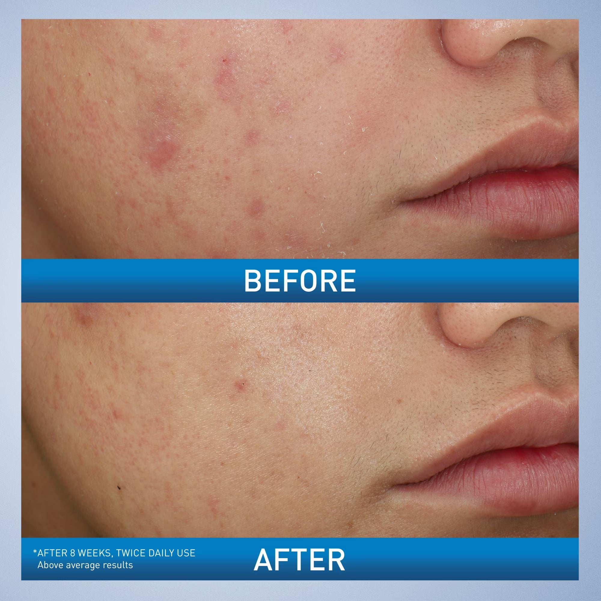 CeraVe Acne Foaming Cream Face Wash, 10% Benzoyl Peroxide Treatment, 5 fl oz
