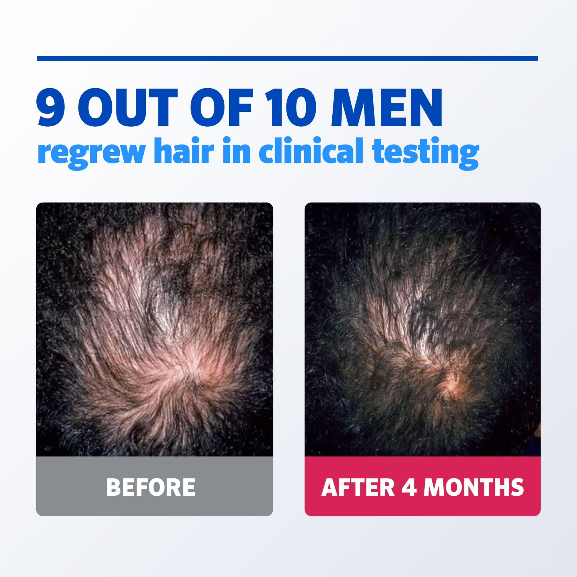 Men's Rogaine 5% Minoxidil Foam Hair Loss Treatment, 1-Month Supply